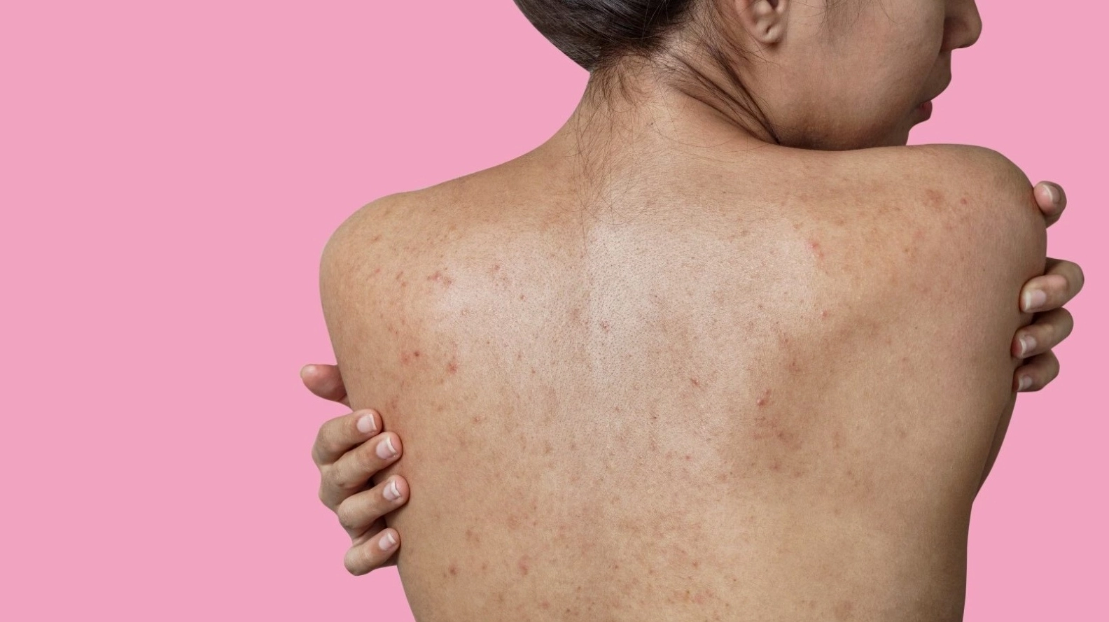 Mụn mọc khắp người là bệnh gì và những lưu ý y khoa quan trọng