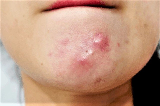 Mụn mọc quanh cằm là bệnh gì và những nguyên nhân y khoa tiềm ẩn