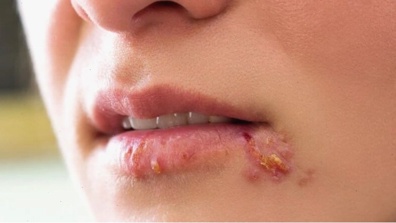 Mụn nước li ti xuất hiện quanh khóe miệng