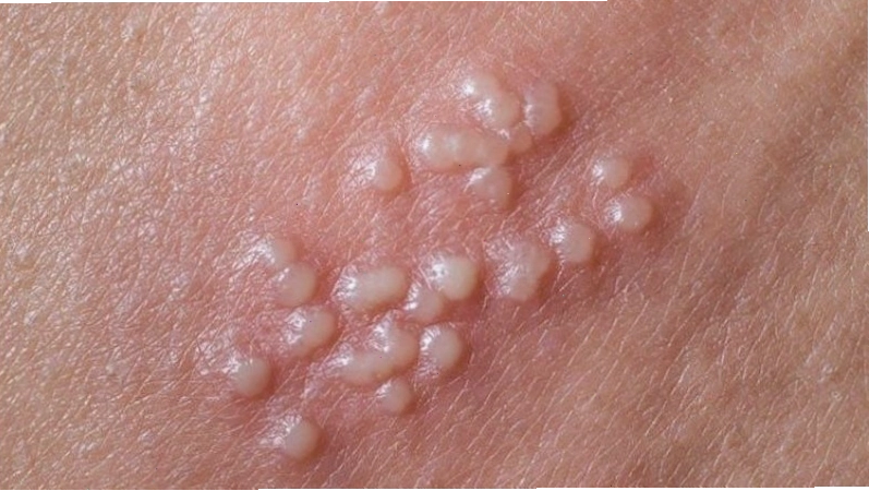 Mụn nước mọc thành chùm là dấu hiệu điển hình của bệnh Herpes sinh dục