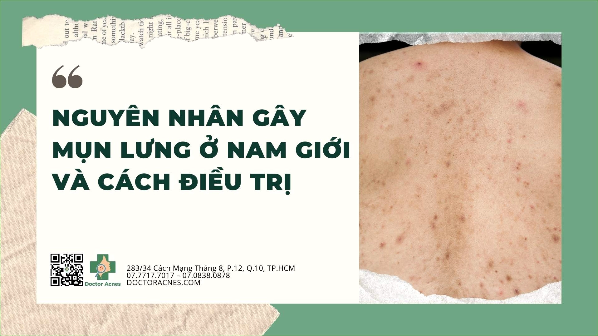 Mụn ở lưng nam giới là bệnh gì và cách kiểm soát tình trạng này hiệu quả