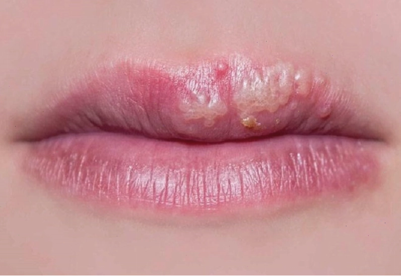 Mụn rộp ở môi do virus gây ra và có khả năng lây nhiễm