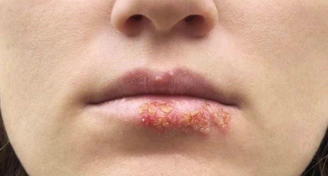 Mụn rộp ở môi là bệnh gì và cách kiểm soát tình trạng nhiễm virus