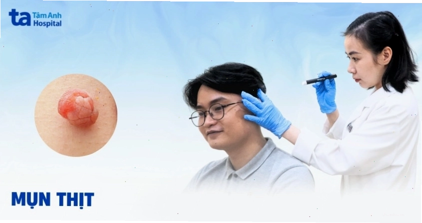 Mụn thịt dư hình thành trên vùng da nhạy cảm