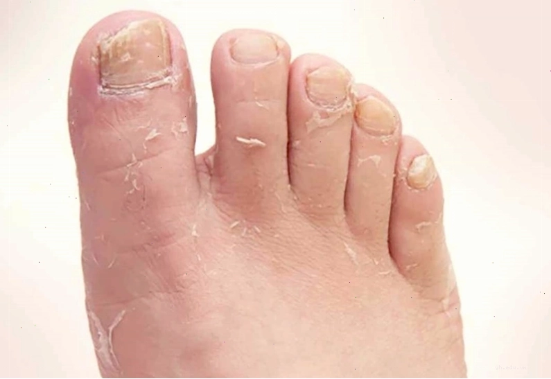 Nấm bàn chân chủ yếu do nấm Trichophyton rubrum gây ra