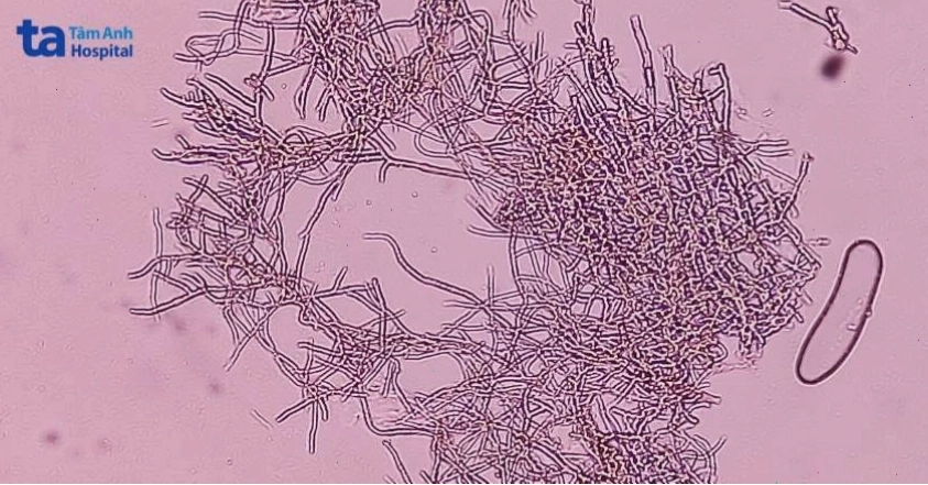 Nấm Dermatophytes là nguyên nhân chủ yếu gây nấm da đầu