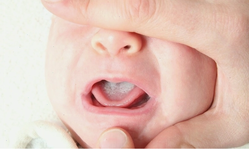 Nấm miệng gây ra lớp màng trắng khó chịu