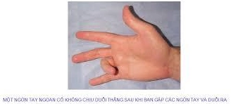 Ngón tay lò xo là bệnh gì và những phương pháp điều trị hiệu quả