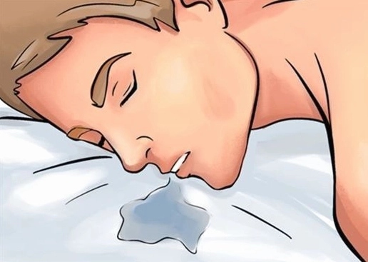 Ngủ chảy ke là bệnh gì và những vấn đề sức khỏe cần lưu ý
