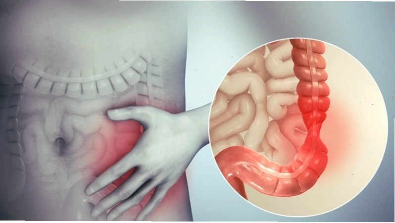 Người bệnh đau bụng do hội chứng ruột kích thích