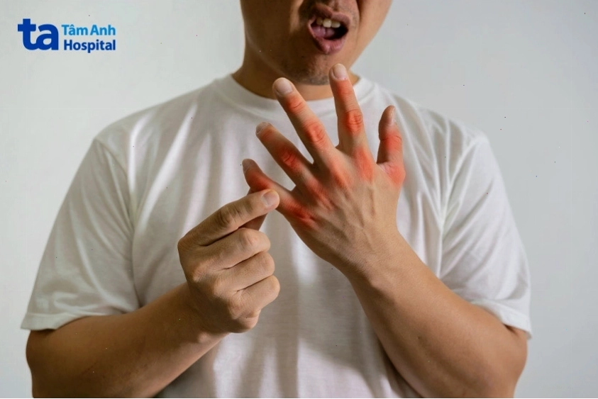 Người bệnh gout có nguy cơ bị biến dạng ngón tay