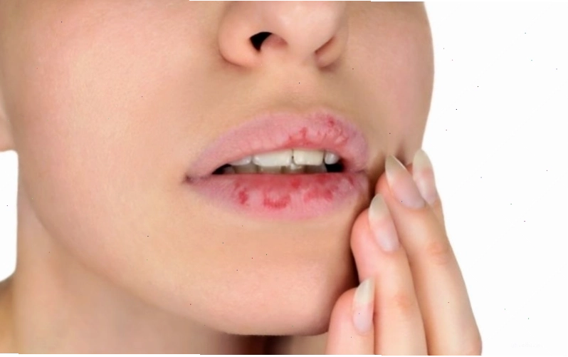 Người bệnh khó chịu do ngứa rát