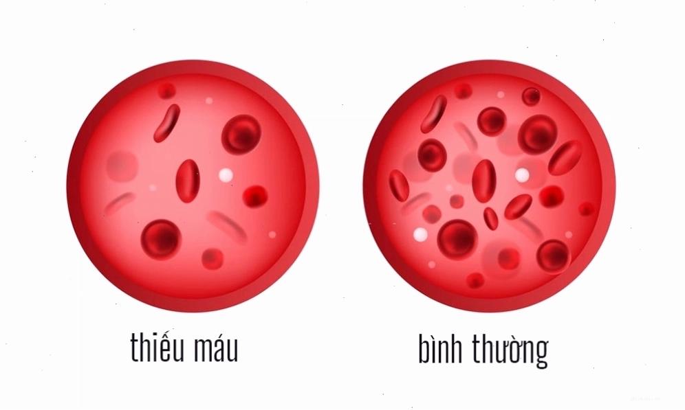 Người bị thiếu máu thiếu sắt