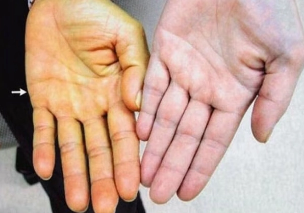 Người lớn bị vàng da là bệnh gì và những lưu ý y khoa quan trọng