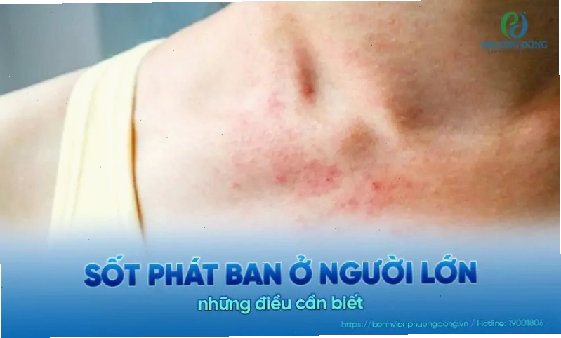 Người lớn mắc bệnh sốt phát ban