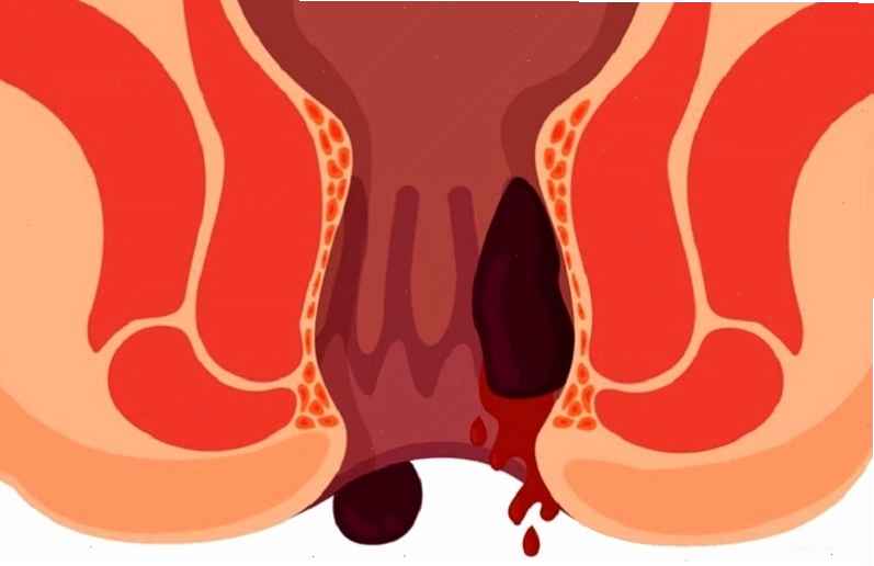 Người mắc bệnh trĩ thường bị chảy máu hậu môn khi đi đại tiện