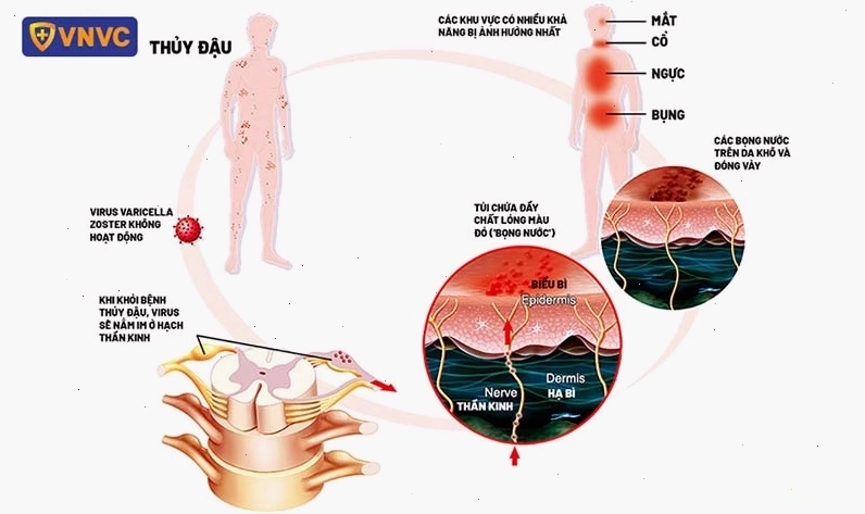 Nguyên nhân gây bệnh Zona thần kinh