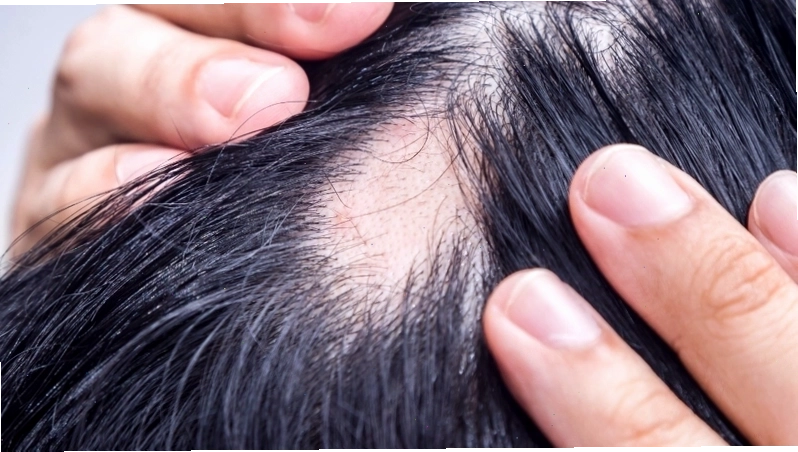 Nguyên nhân rụng tóc