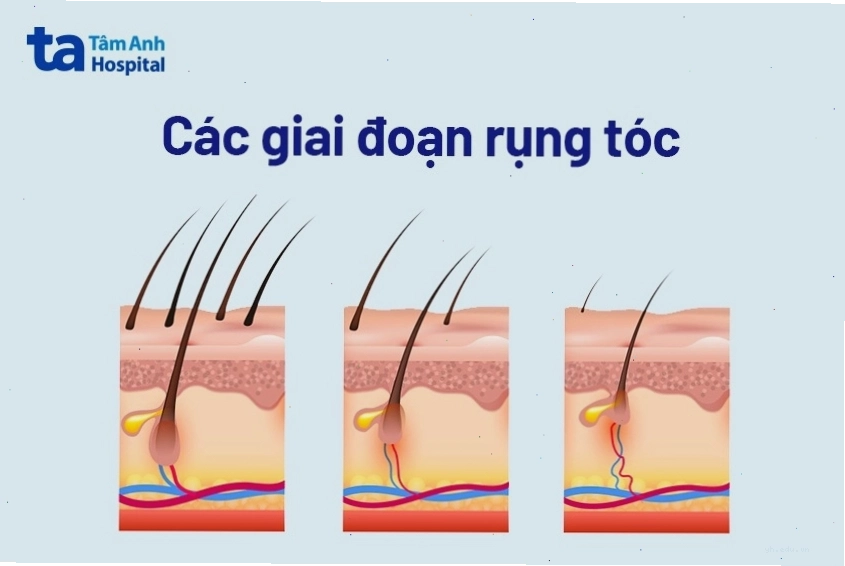 nguyên nhân rụng tóc nhiều bất thường
