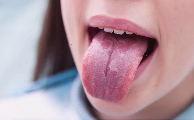 Nhận biết hình ảnh viêm gai lưỡi phổ biến để có phương pháp điều trị kịp thời