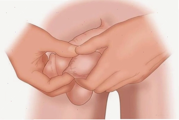 Nhiễm nấm da vùng tinh hoàn gây ngứa và mụn