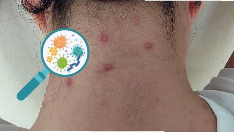 Nhiễm trùng da là tình trạng viêm nhiễm da do vi sinh vật gây ra