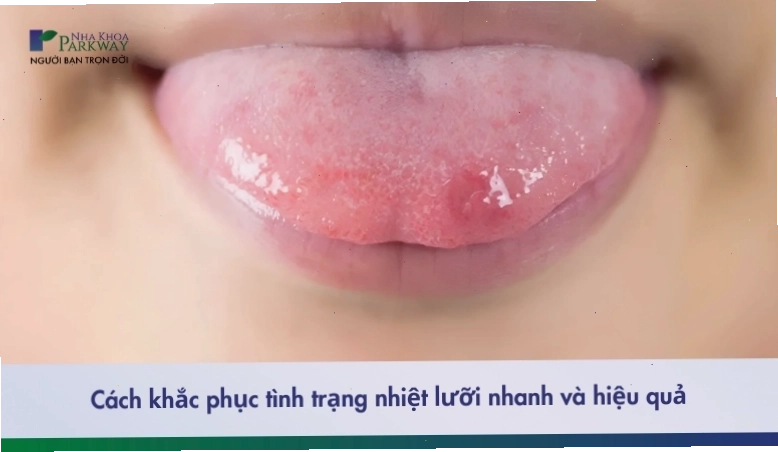 Nhiệt lưỡi và cách khắc phục