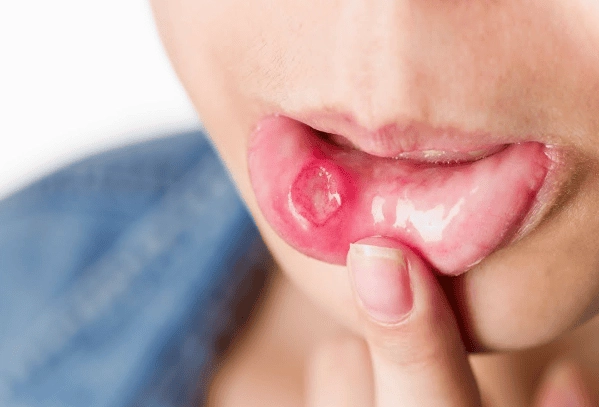 Nhiệt miệng kéo dài là bệnh gì và những lưu ý y khoa quan trọng