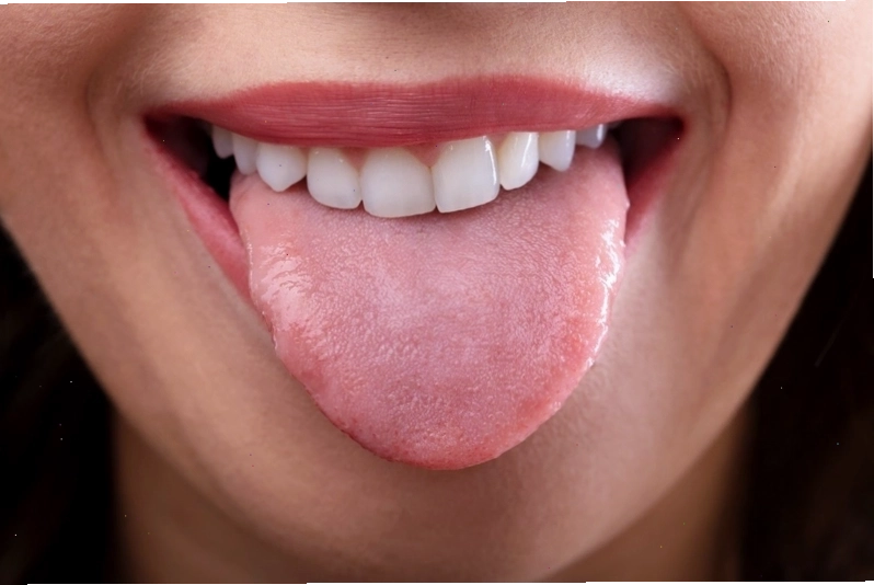 Nhiệt miệng ở lưỡi