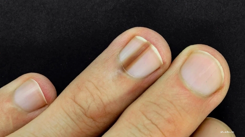 Nhiều người thường hỏi móng tay bị thâm đen là bệnh gì
