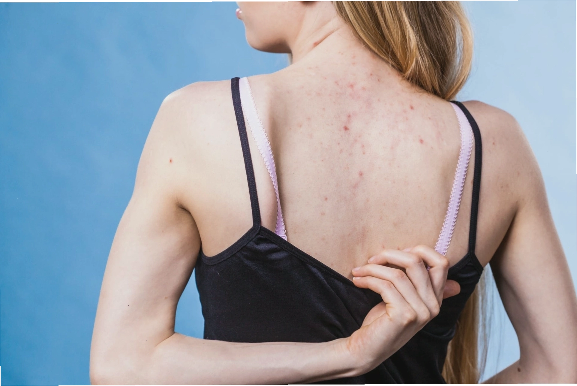 Nhiều nguyên nhân gây ra tình trạng mụn lưng mụn ngực ở cả nam và nữ