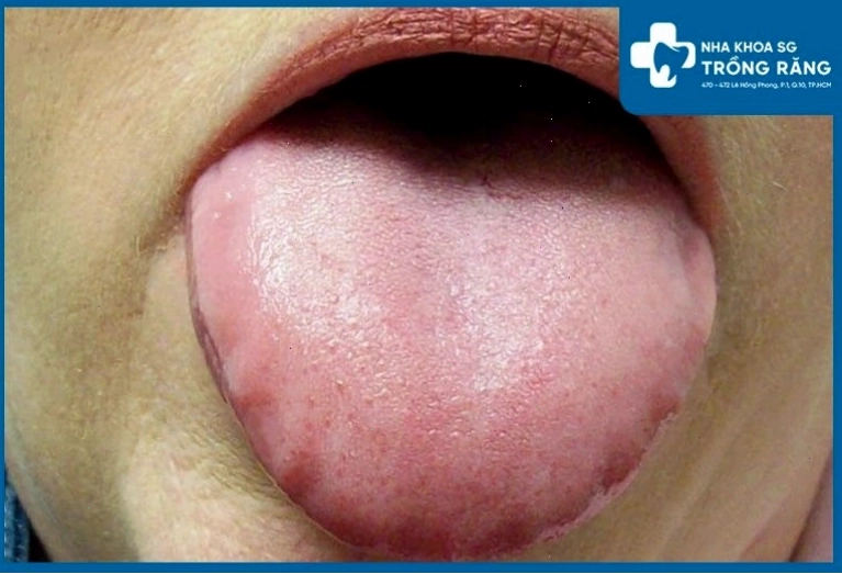 Nhú lưỡi xuất hiện một số hạt đỏ nhỏ khiến người bệnh cảm thấy khó chịu