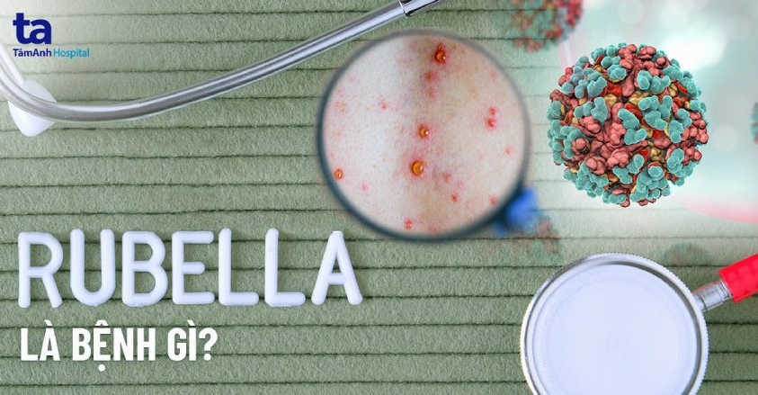 Những hiểu biết khoa học về virus rubella gây ra bệnh gì về mắt