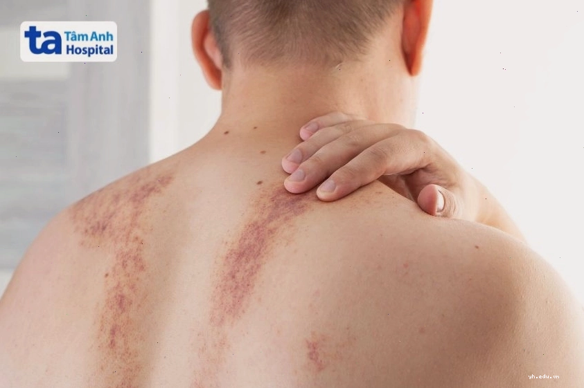 Những vết bầm lớn xuất hiện ở vùng lưng