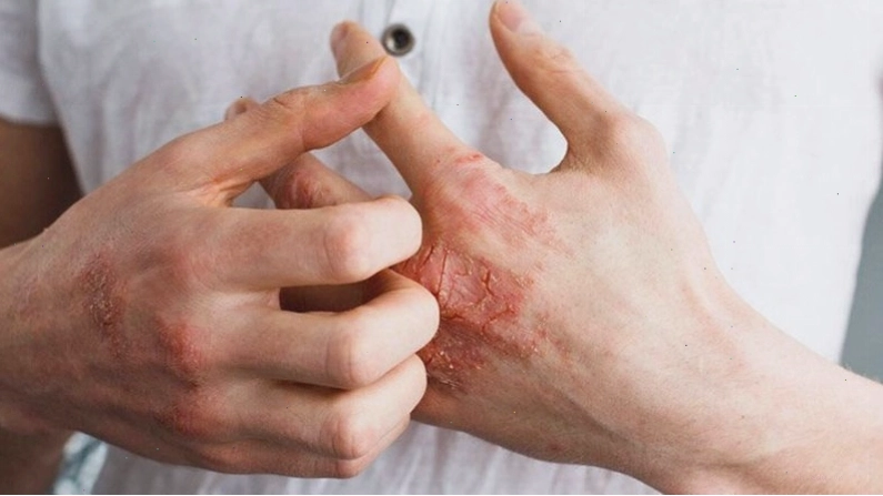 Nổi ban đỏ có thể là triệu chứng của giang mai