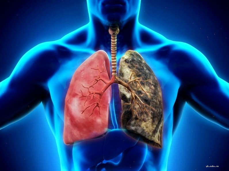 Nói chuyện bị hụt hơi là dấu hiệu của bệnh gì