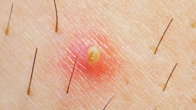 Nổi hạch ở vùng kín là bệnh gì và những điều bạn nên biết