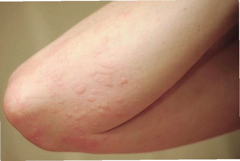 Nổi mề đay là tình trạng dị ứng trên da thường gặp