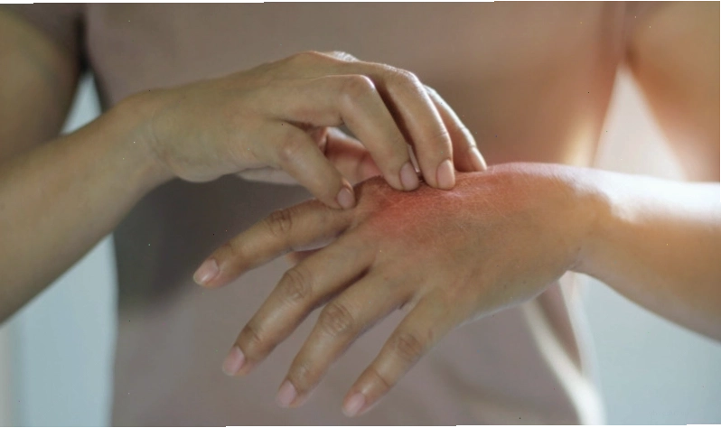 Nổi mề đay thường tự hết sau một vài ngày