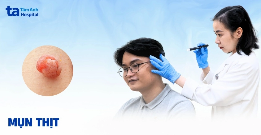 Nổi thịt dư là bệnh gì và những điều cần biết để bảo vệ sức khỏe