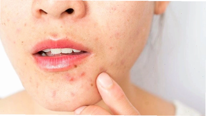 Nóng trong người là nguyên nhân gây mụn