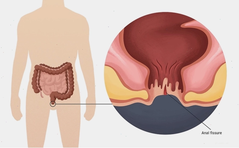 Nứt kẽ hậu môn là một trong những biến chứng thường gặp của bệnh nhân táo bón