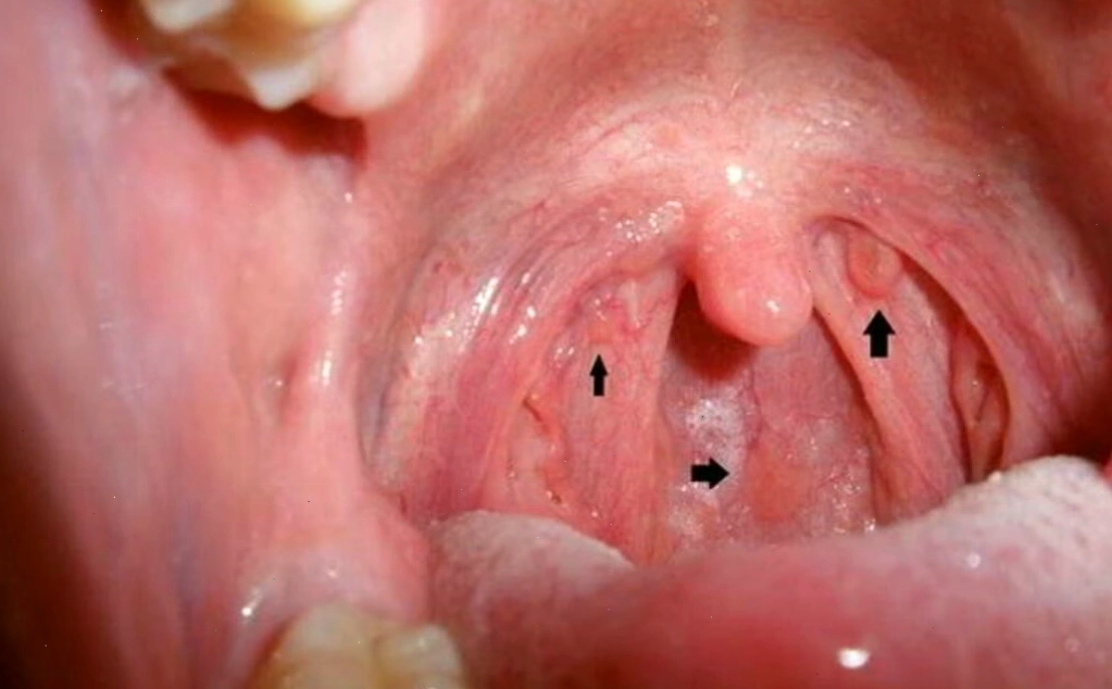 Phân biệt các loại tổn thương da tại vùng miệng