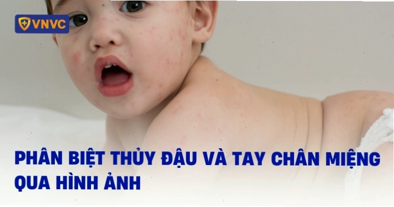 Phân biệt thủy đậu và tay chân miệng