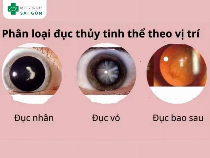 Phân loại đục thủy tinh thể theo vị trí