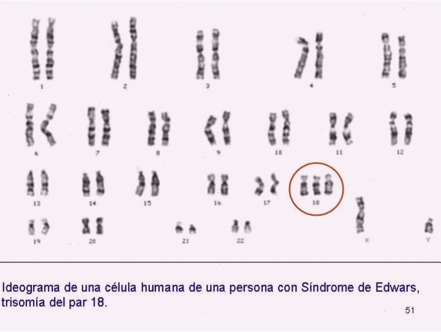 Phân tích công thức nhiễm sắc thể tế bào cho thấy sự dư thừa nhiễm sắc thể 18