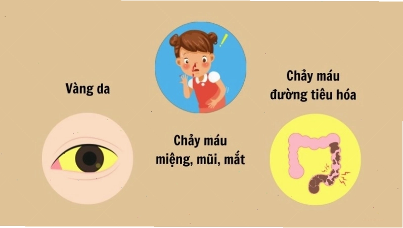 Phòng ngừa bệnh sốt vàng