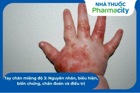 Phòng ngừa biến chứng tay chân miệng