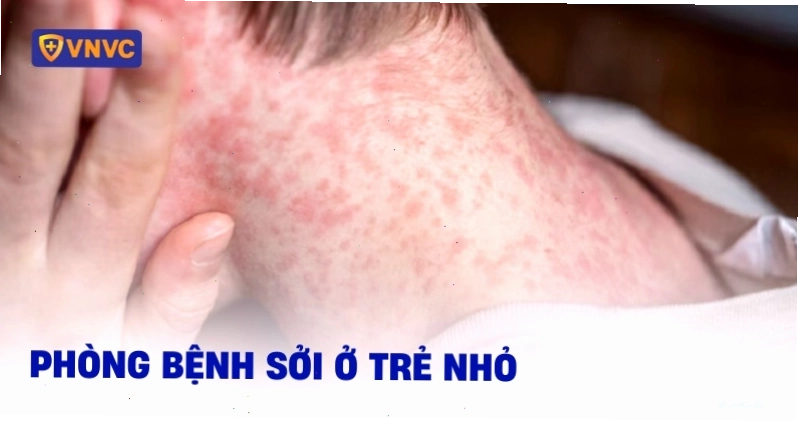 phòng tránh bệnh sởi ở trẻ