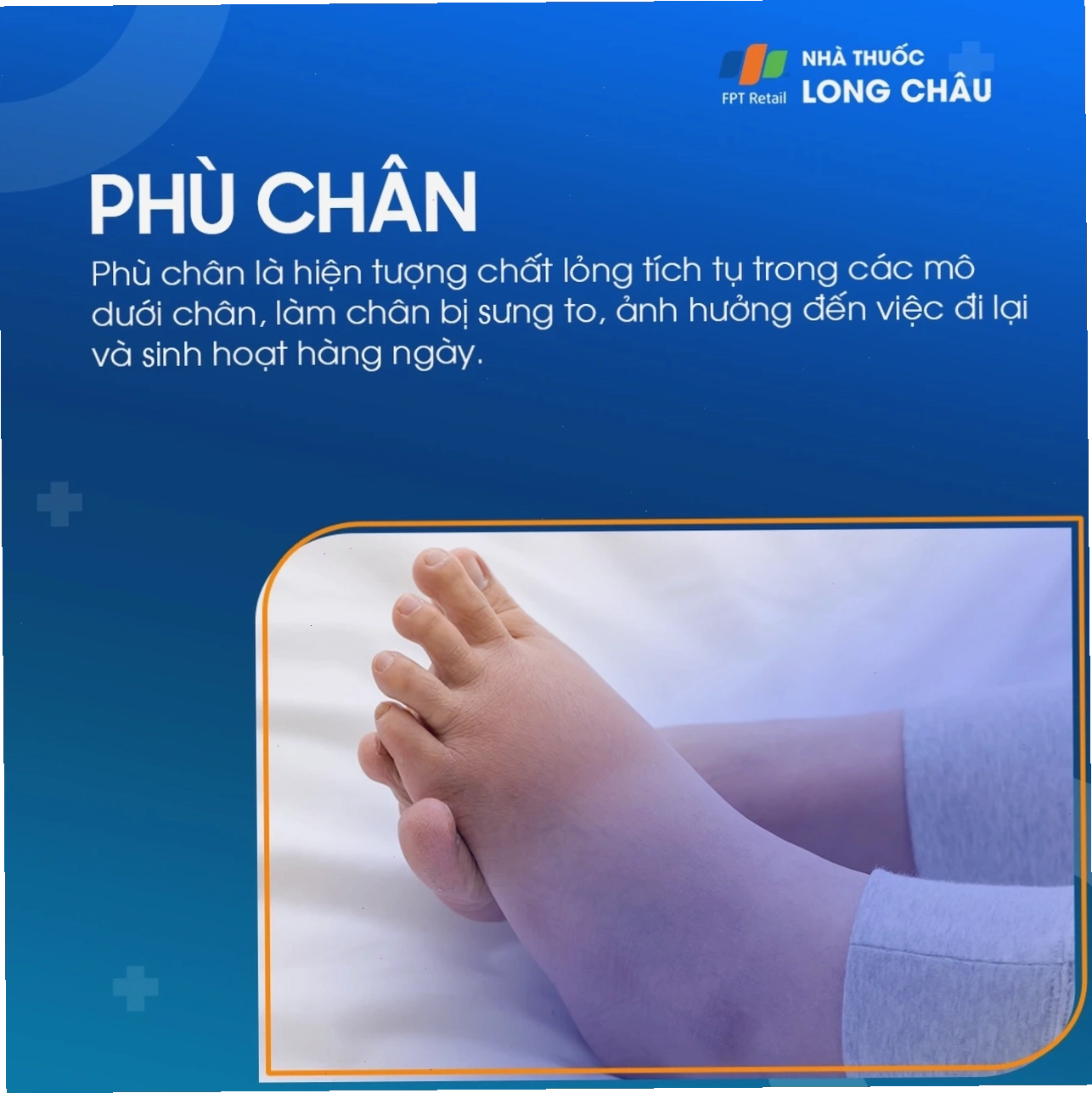 Phù chân giai đoạn 1